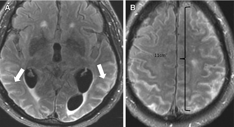 ARIA in man receiving aducanumab