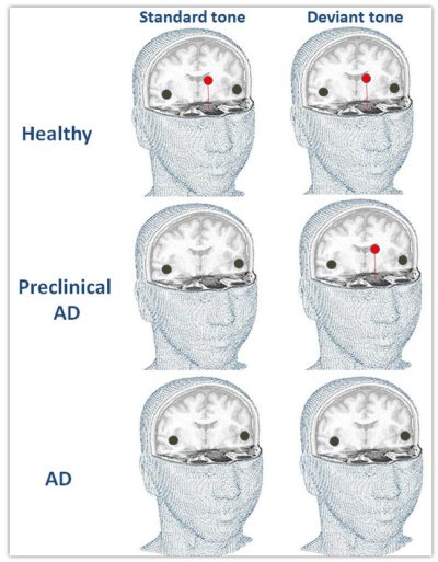 Biomarcatore 'ideale', non invasivo, rileva l'Alzheimer prima dei sintomi