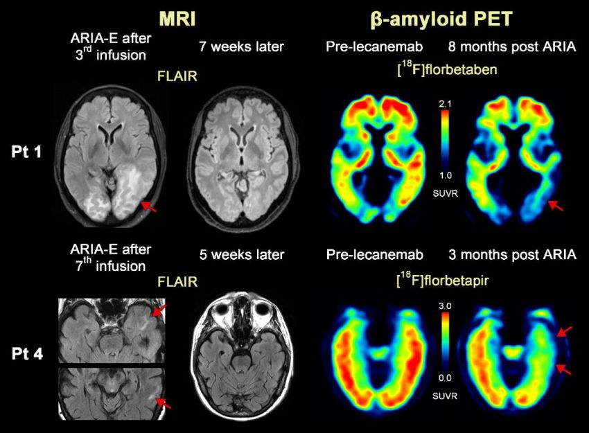 Alzheimer treatment side effect by HoustonMethodist