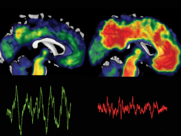 Il sonno può essere un pezzo mancante nel puzzle dell'Alzheimer.