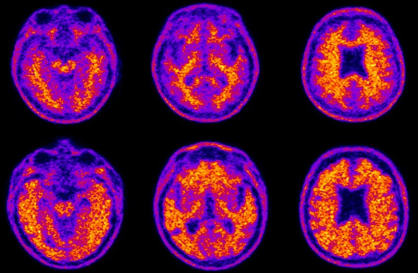 Amyloid Plaques