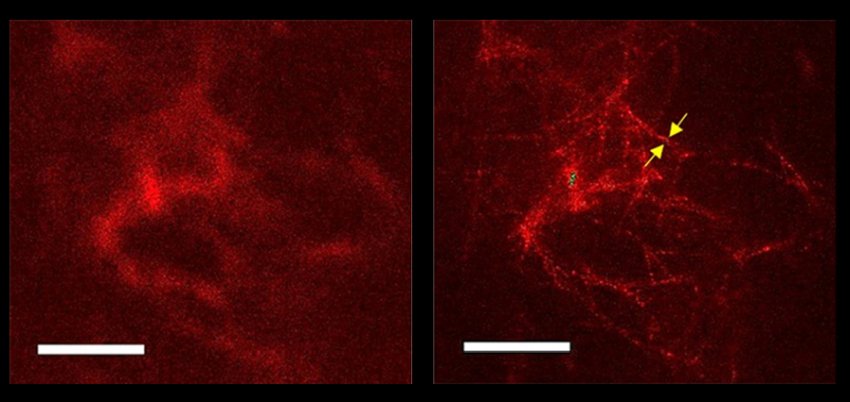 Amyloid plaques with STED