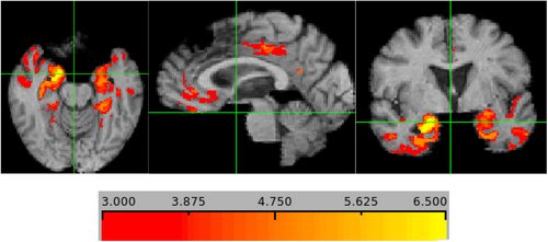 Assoc gray matter thickness