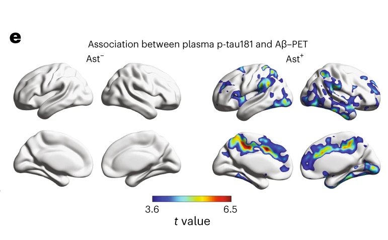 Association between plasma p tau181 and amiloide beta 