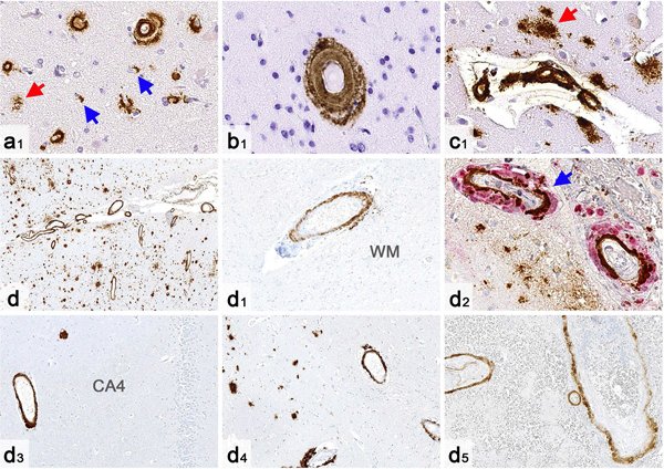 L'amiloide si potrebbe trasmettere tra persone diverse con la neurochirurgia