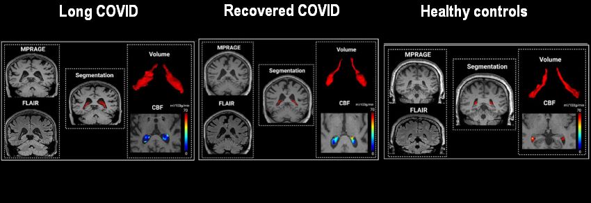 Choroid plexus enlargment by Pang et al AlzDem
