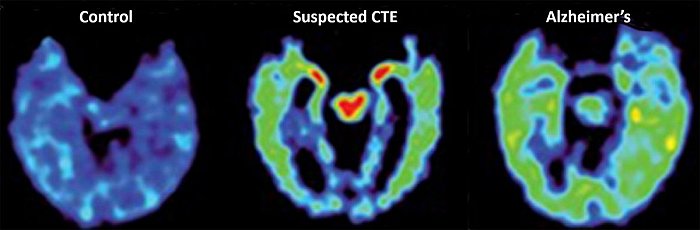 Commozioni cerebrali ripetute portano a danni simili all'Alzheimer