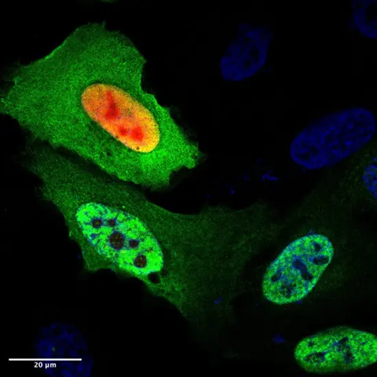 DAXX red top prevents aggregation of mutant p53 protein