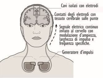 Stimolazione cerebrale profonda è promettente per over-65 con Alzheimer lieve