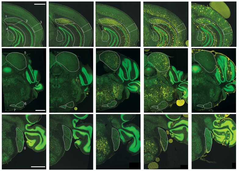 Differential amyloid plaque accumulation