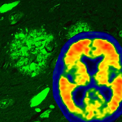 Ancora conferme che è la Tau il vero motore dell'Alzheimer