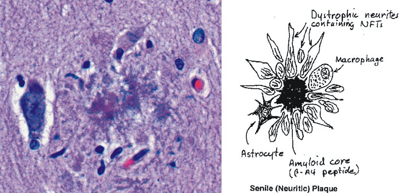 E' la fabbrica di proteine della cellula il punto-chiave del declino cognitivo da vecchiaia e Alzheimer?