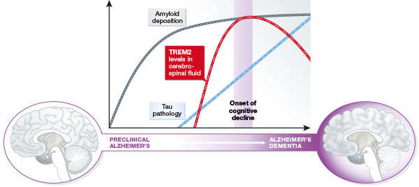 Identificato nuovo biomarcatore che può predire l'insorgenza dell'Alzheimer