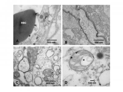 Secondo i ricercatori, il problema di avere nanoparticelle derivate dalla combustione nei cervelli dei bambini - sviluppando i cervelli - è molto grave. Queste particelle sono onnipresenti e presenti in concentrazioni elevate nei bambini fino a 3 anni. Le particelle contengono metalli neurotossici di transizione e sono certamente causando danni cerebrali estesi in organi chiave. 