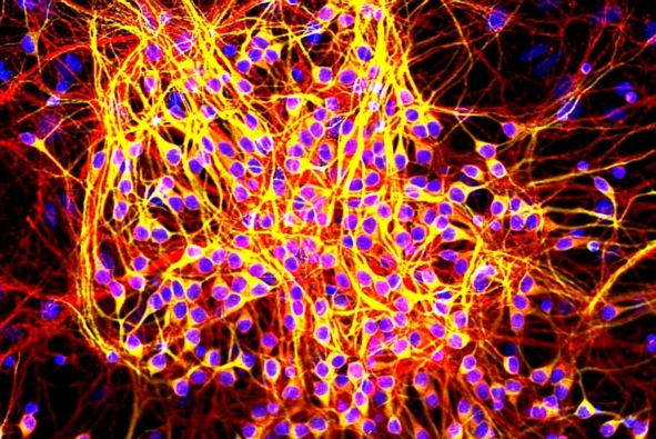 Malattia rara e poco nota può darci una chiave per curare l'Alzheimer