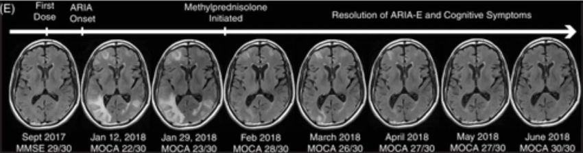 Gibbs FLAIR MRI six months after onset of symptoms