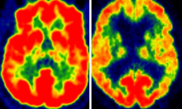 Studio sull'AD collega salute del cervello e attività fisica