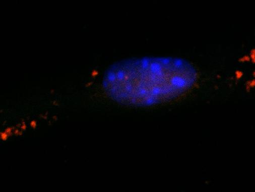 La mancata scomposizione dei grassi nel cervello provoca demenza