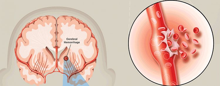 Hemorrhagic Stroke