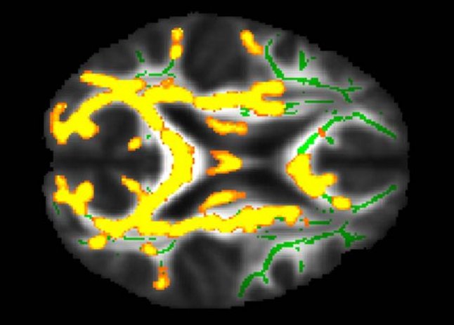 Higher brain inflammation 