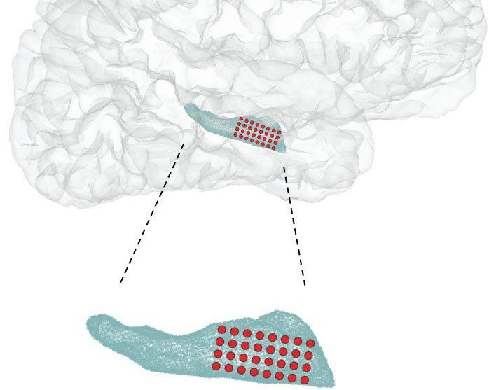 Hippocampus electrode Kleen