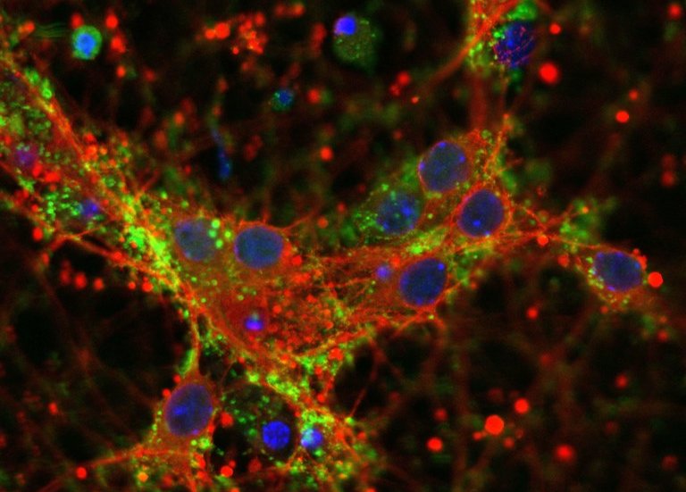 In green deposits of alfa synuclein