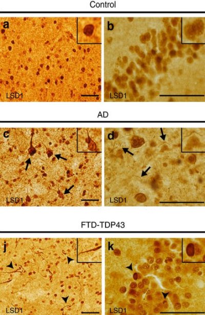 Come muoiono le cellule cerebrali nell'Alzheimer e nella FTD