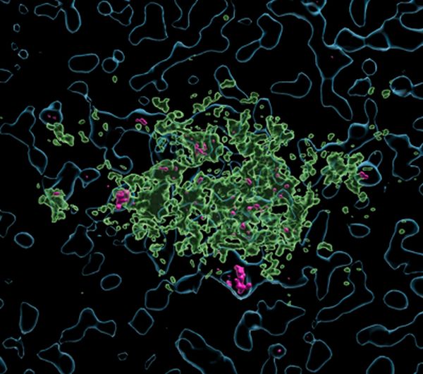 Lecanemab pink taken up by human microglia light blue surrounding amyloid plaques green by VB KU Leuven