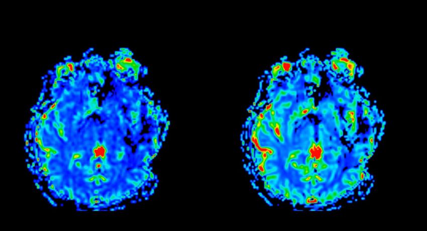 MRI brain scans by UCSF