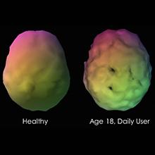 L'uso di marijuana riduce il flusso di sangue al cervello, aumentando il rischio di Alzheimer