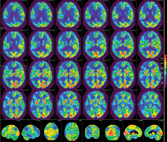 Mancanza di diagnosi crea rischi aggiuntivi per chi ha una demenza