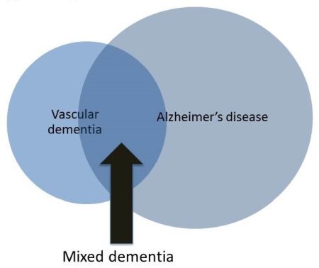 Cosa significa 'demenza mista'?