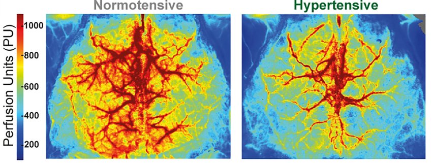 Normo and hypertensive brain vasculature 