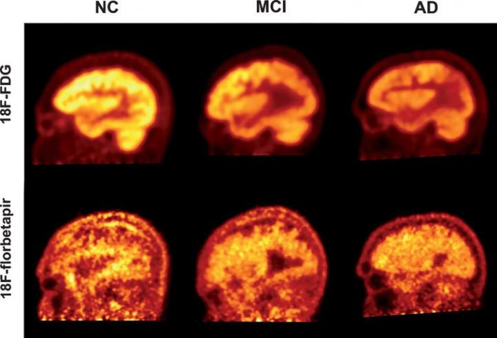 PET imaging florbetapir vs fdg