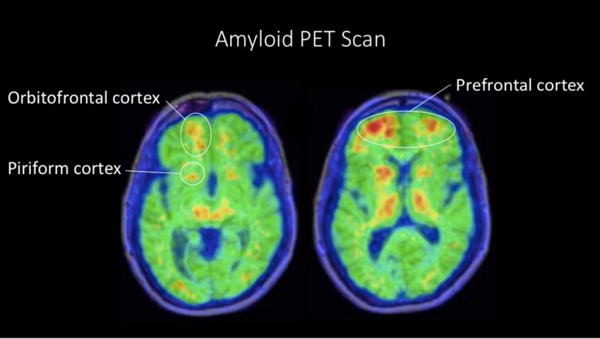 PET amyloid scan by dr Gil Rabinovici UCSF