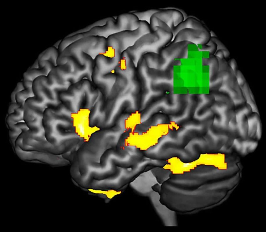 PPA dementia detection