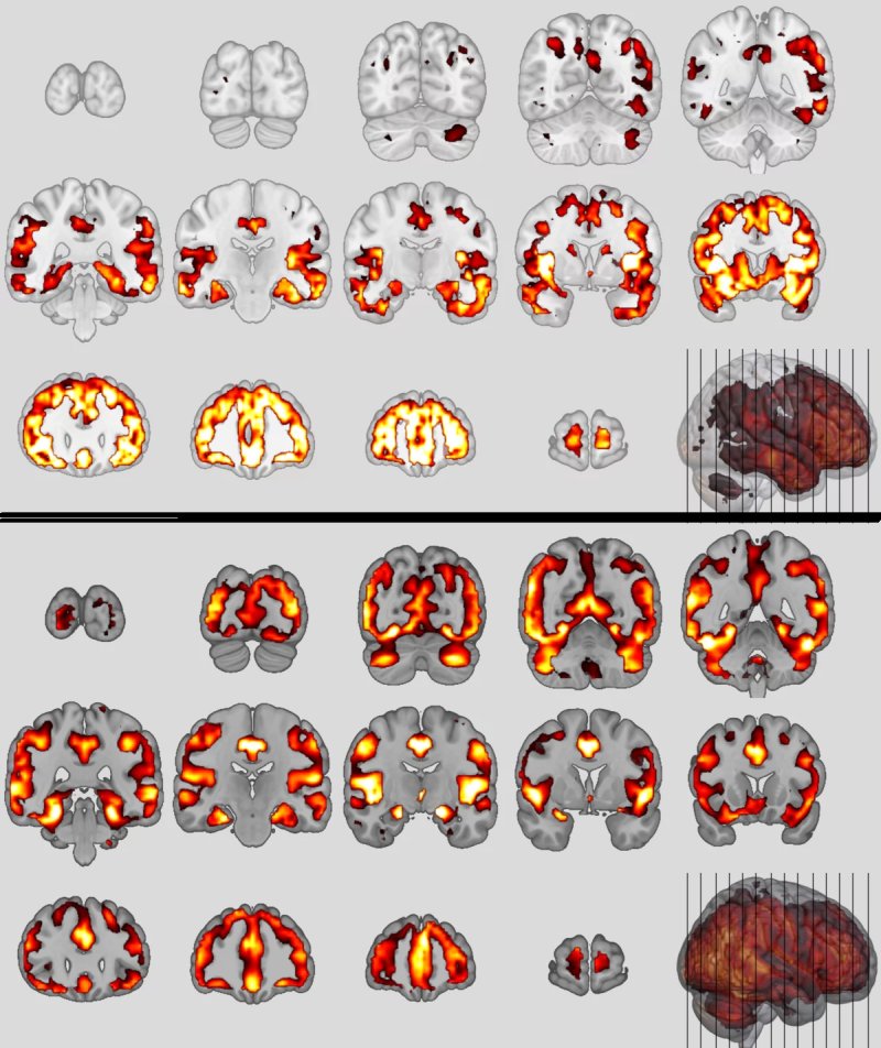 Patterns of bvFTD top and schizophrenia bottom