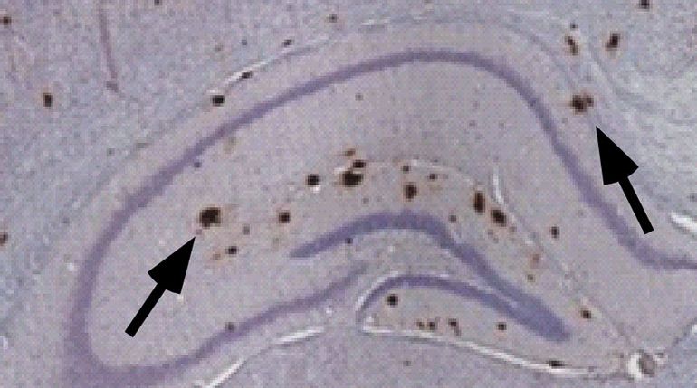 Le radici dell'Alzheimer possono partire addirittura dal grembo materno