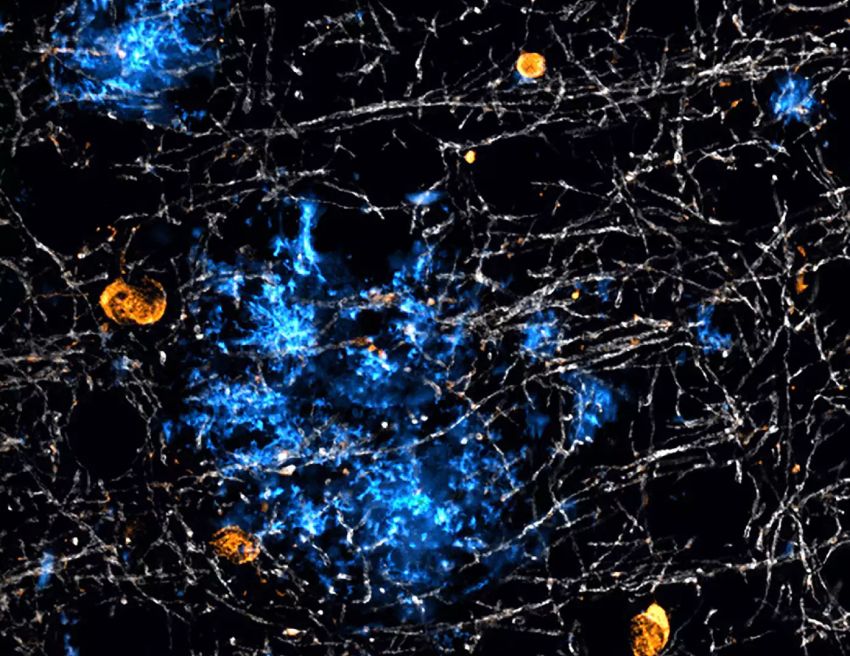 Plaques of amyloid beta by MPI AO Sasmita