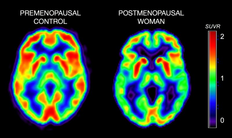 La connessione tra menopausa e Alzheimer