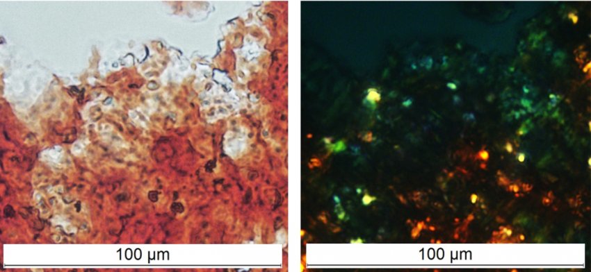 Protein FXR1 colourised with amyloid red