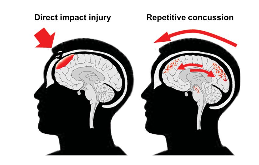 Repetitive injury induces phenotypes associated with Alzheimer 