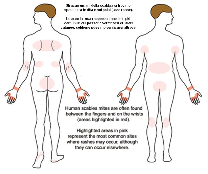 Sites of scabies CDC