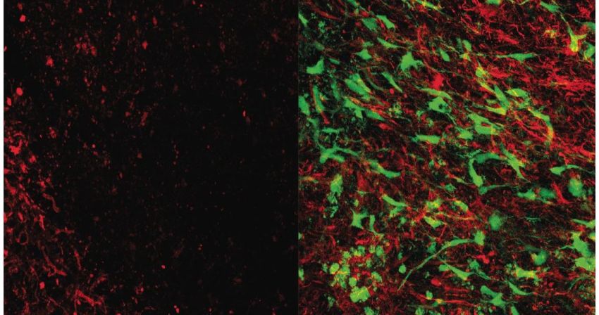 Stroke comparison UCLA hero