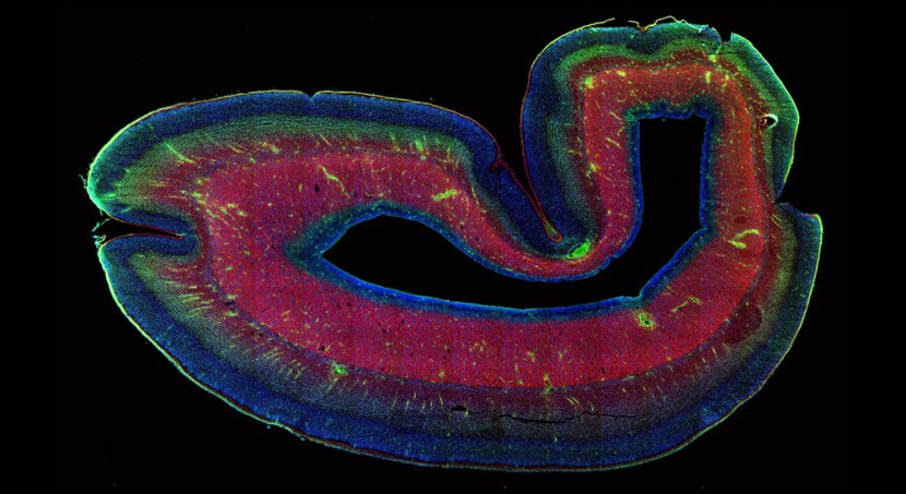 Scienziati risolvono il caso della subplacca mancante: implicazioni per la scienza del cervello