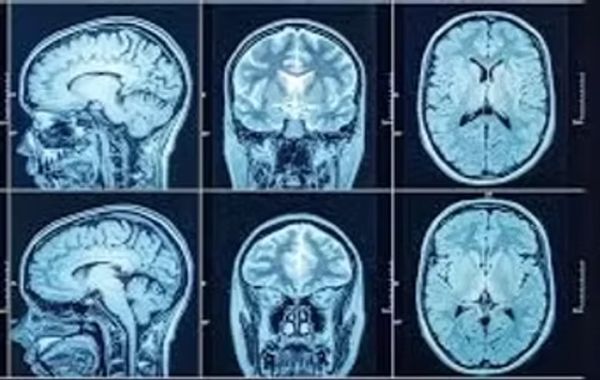TAC dopo ictus cerebrale ischemico da praticolab dot org