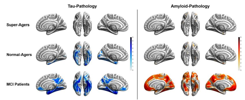 Tau blue and amyloid orange distribution patterns