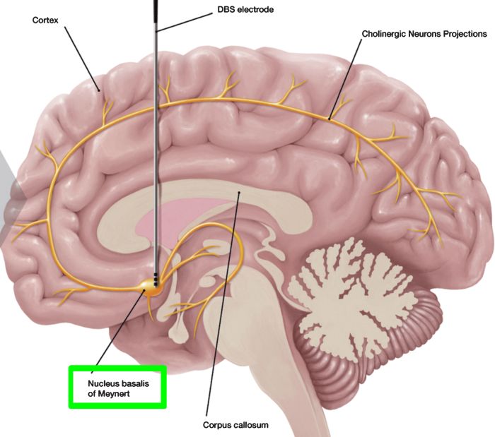 The Nucleus Basalis of Meynert Koulousakis et al jAlzDis