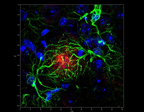 Confermato nuovo meccanismo dell'Alzheimer