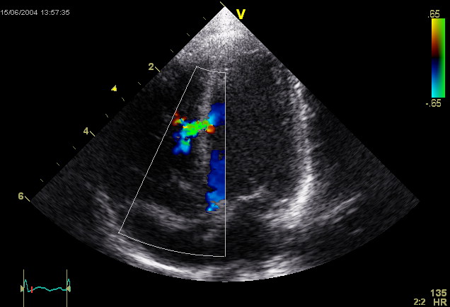 Ventricular Septal Defect echocardiography